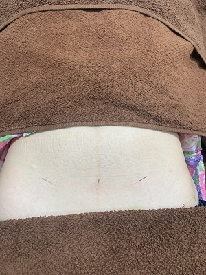 鍼灸卵巣に働きかける鍼