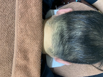 頭痛、眩暈の鍼施術の写真