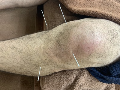 変形性膝関節症の鍼施術の写真