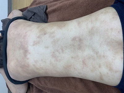 アトピー性皮膚炎の鍼施術の写真